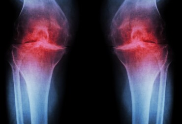 osteoarthritis of knees icd 10