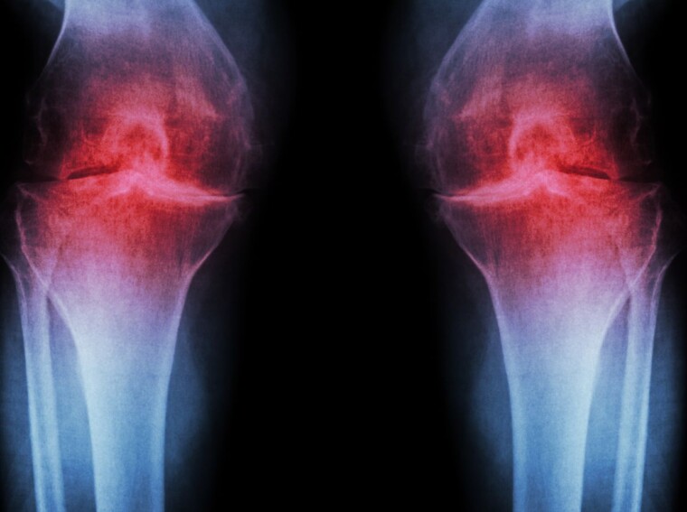 osteoarthritis of knees icd 10