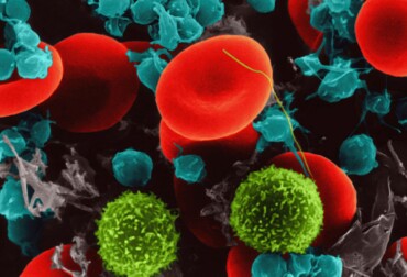 low lymphocytes high neutrophils
